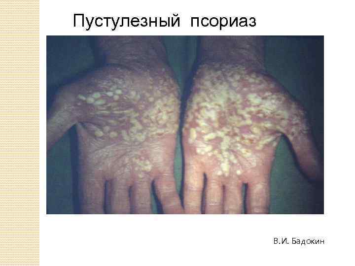 Пустулезный псориаз В. И. Бадокин 