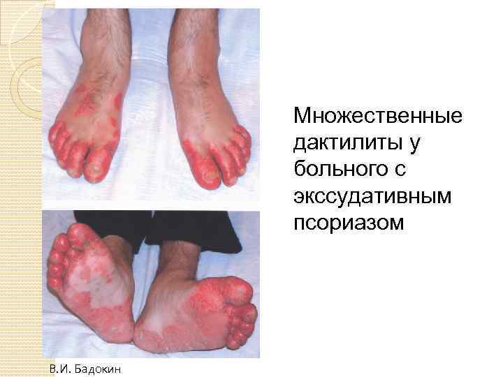 Множественные дактилиты у больного с экссудативным псориазом В. И. Бадокин 