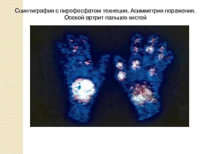 Сцинтиграфия с пирофосфатом технеция. Асимметрия поражения. Осевой артрит пальцев кистей 