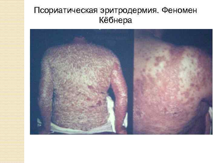 Псориатическая эритродермия. Феномен Кёбнера 