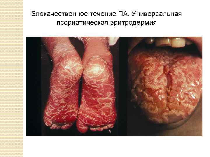Злокачественное течение ПА. Универсальная псориатическая эритродермия 