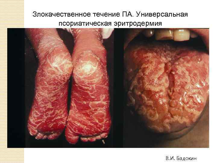 Злокачественное течение ПА. Универсальная псориатическая эритродермия В. И. Бадокин 