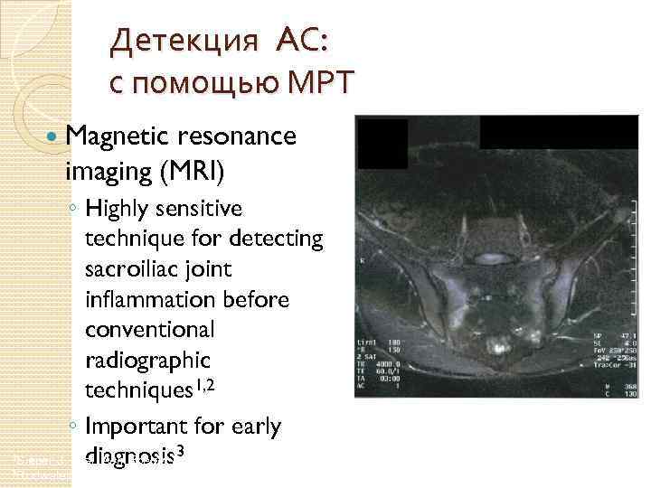 Детекция AС: с помощью МРТ Magnetic resonance imaging (MRI) ◦ Highly sensitive technique for