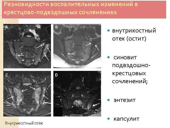 Мрт крестцово подвздошных сочленений. Илеосакральные сочленения кт. Артроз крестцово-подвздошных сочленений мрт. Илеосакральное сочленение мрт. Анкилоз крестцово-подвздошных сочленений мрт.