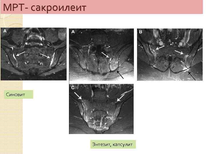 Сакроилеит на мрт фото