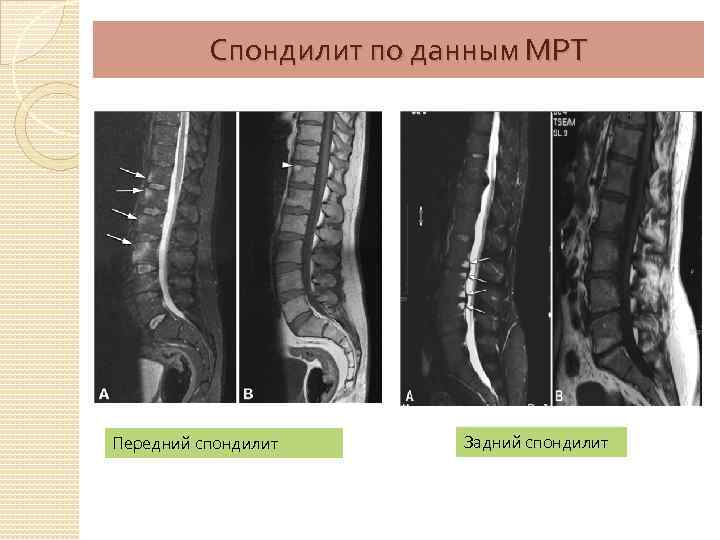 Спондилит. Анкилозирующий спондилит и псориатический артрит. Спондилит поясничного отдела позвоночника мрт. Болезнь Бехтерева мрт позвоночника. Передний спондилит.