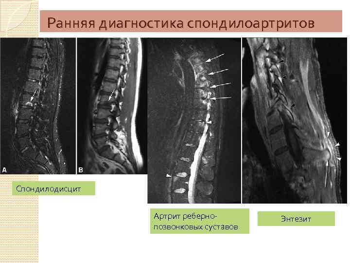 Какую картину дает мрт при болезни бехтерева