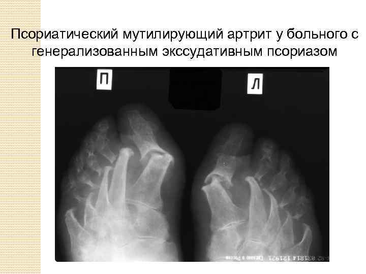 Псориатический артрит презентация