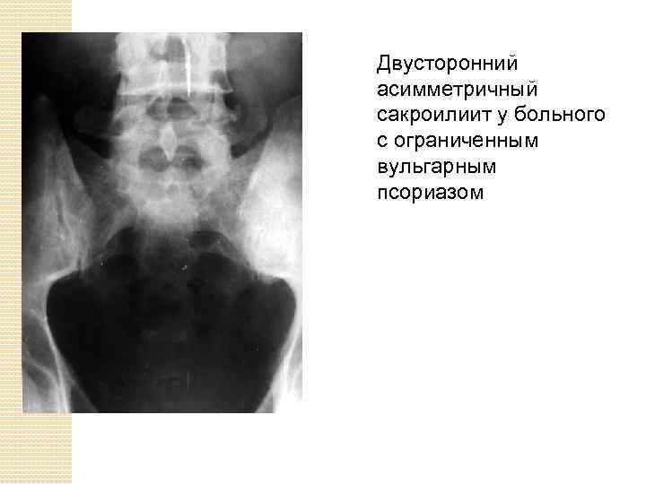 Двусторонний асимметричный сакроилиит у больного с ограниченным вульгарным псориазом 