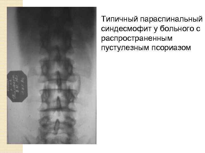 Типичный параспинальный синдесмофит у больного с распространенным пустулезным псориазом 