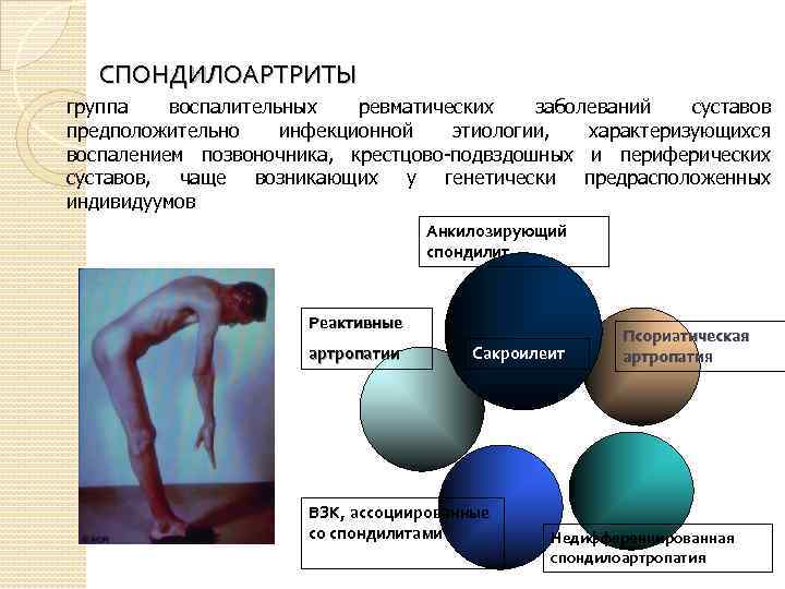 СПОНДИЛОАРТРИТЫ группа воспалительных ревматических заболеваний суставов предположительно инфекционной этиологии, характеризующихся воспалением позвоночника, крестцово-подвздошных и
