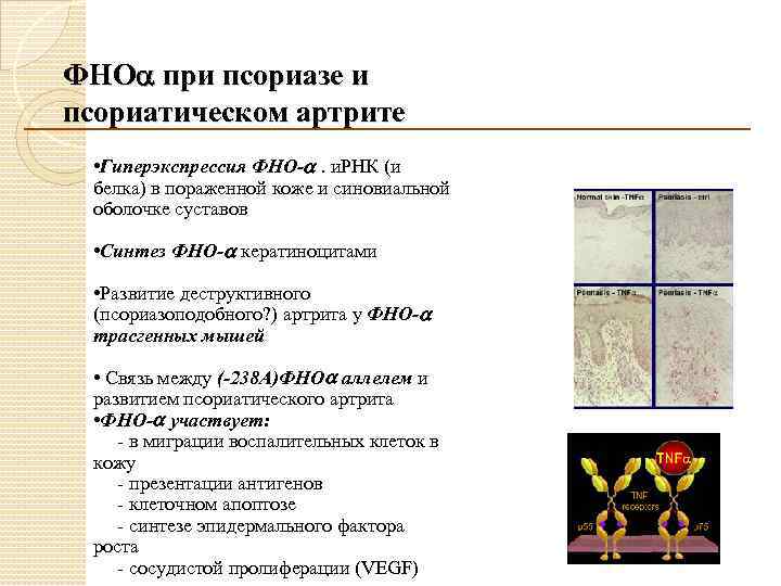 ФНО при псориазе и псориатическом артрите • Гиперэкспрессия ФНО- . и. РНК (и белка)