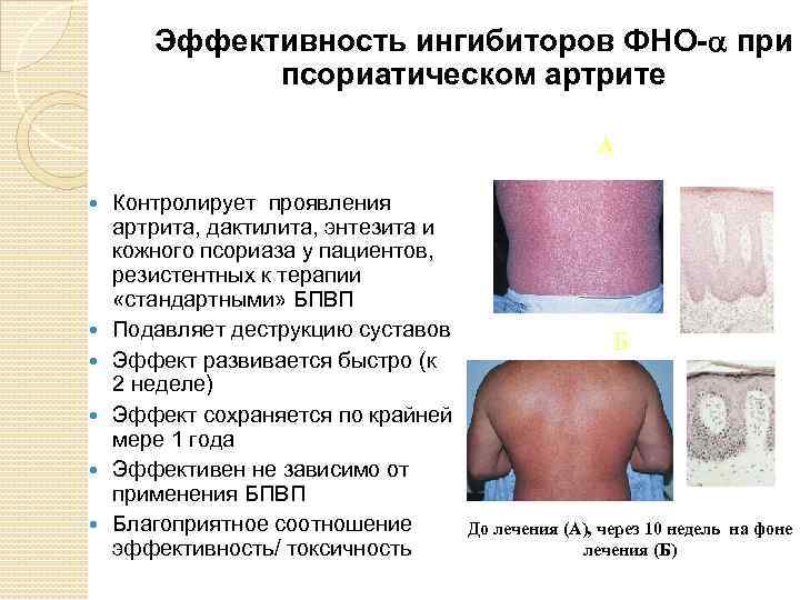 Эффективность ингибиторов ФНО- при псориатическом артрите А Контролирует проявления артрита, дактилита, энтезита и кожного
