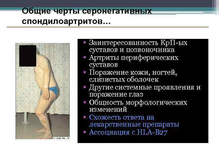Общие черты серонегативных спондилоартритов… Заинтересованность Кр. П-ых суставов и позвоночника Артриты периферических суставов Поражение