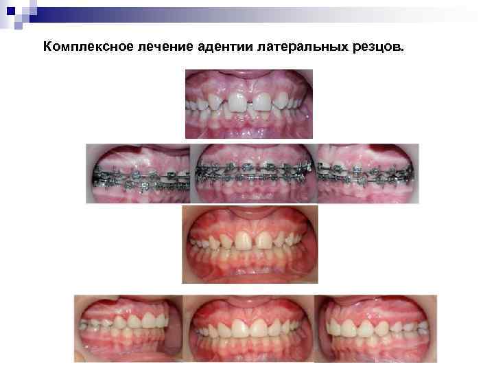 Комплексное лечение адентии латеральных резцов. 