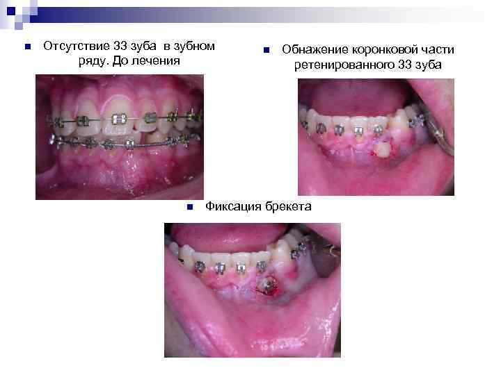 n Отсутствие 33 зуба в зубном ряду. До лечения n n Обнажение коронковой части