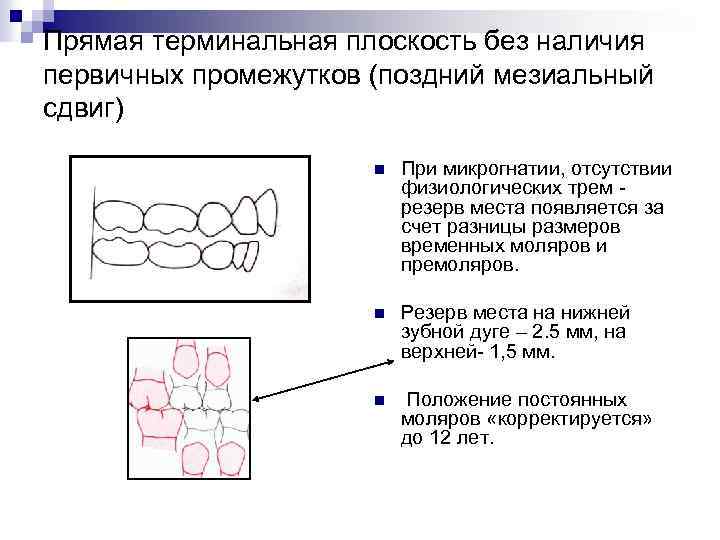 Прямая терминальная плоскость без наличия первичных промежутков (поздний мезиальный сдвиг) n При микрогнатии, отсутствии