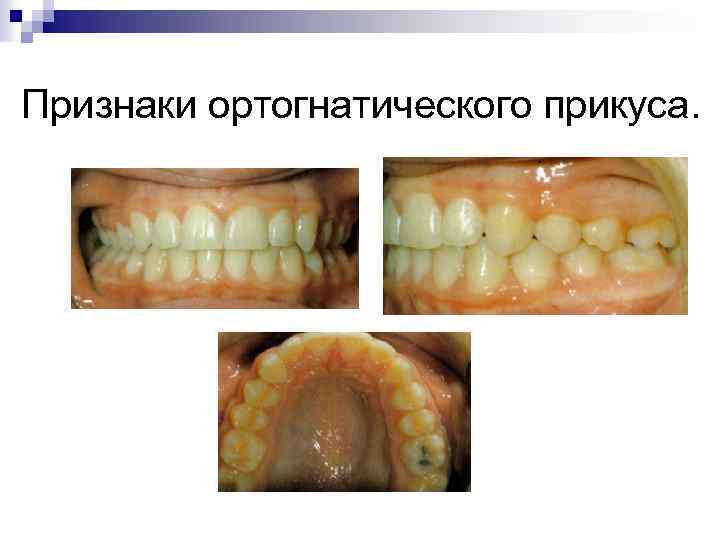 Признаки ортогнатического прикуса. 