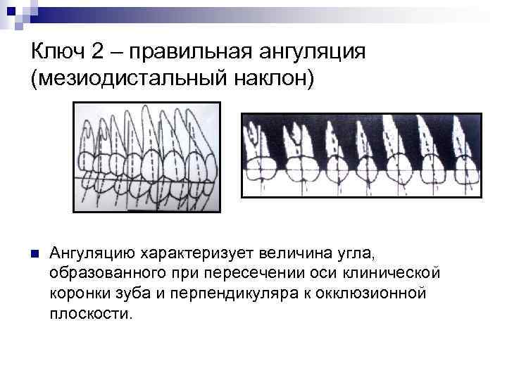 Ключ 2 – правильная ангуляция (мезиодистальный наклон) n Ангуляцию характеризует величина угла, образованного при