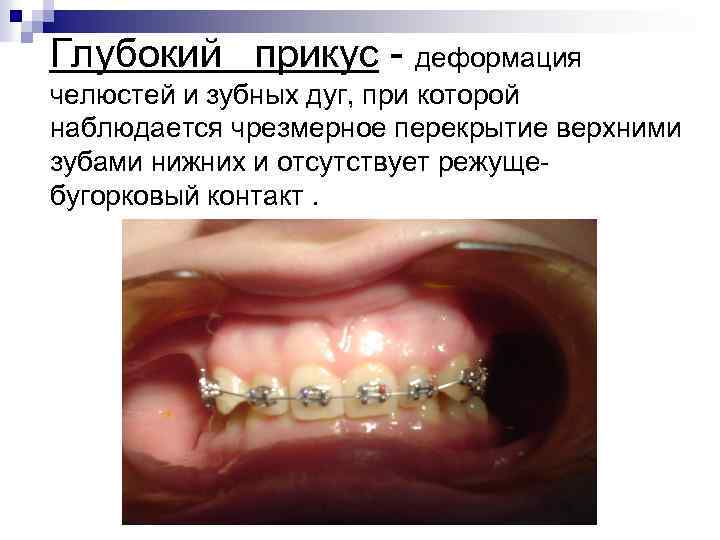 Глубокий прикус - деформация челюстей и зубных дуг, при которой наблюдается чрезмерное перекрытие верхними