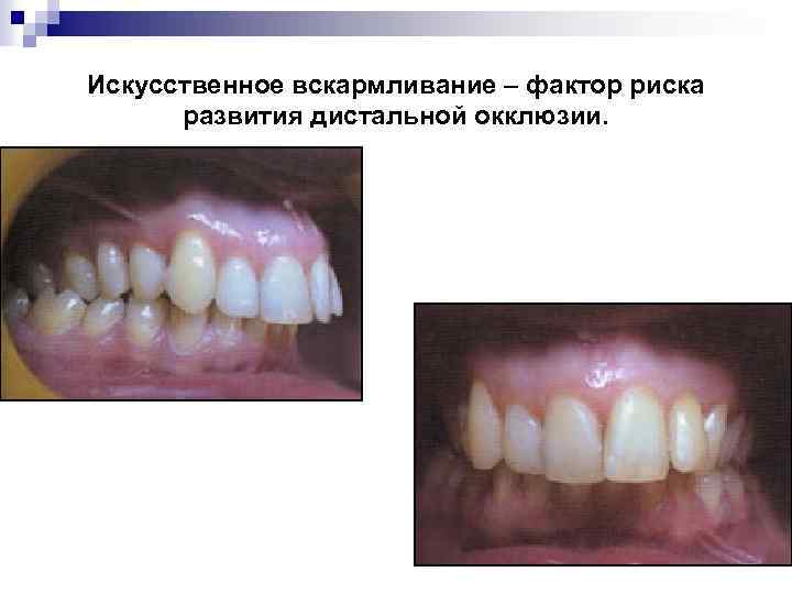 Искусственное вскармливание – фактор риска развития дистальной окклюзии. 