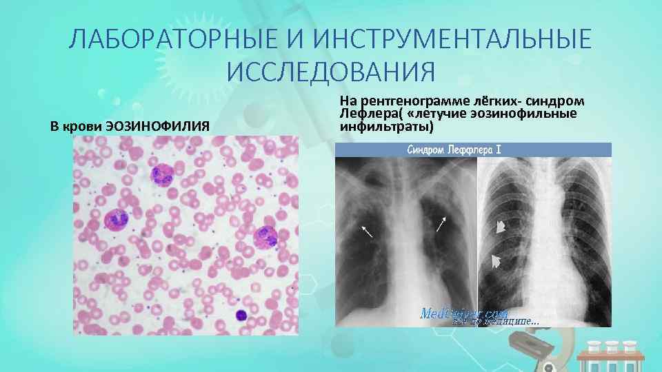 ЛАБОРАТОРНЫЕ И ИНСТРУМЕНТАЛЬНЫЕ ИССЛЕДОВАНИЯ В крови ЭОЗИНОФИЛИЯ На рентгенограмме лёгких- синдром Лефлера( «летучие эозинофильные
