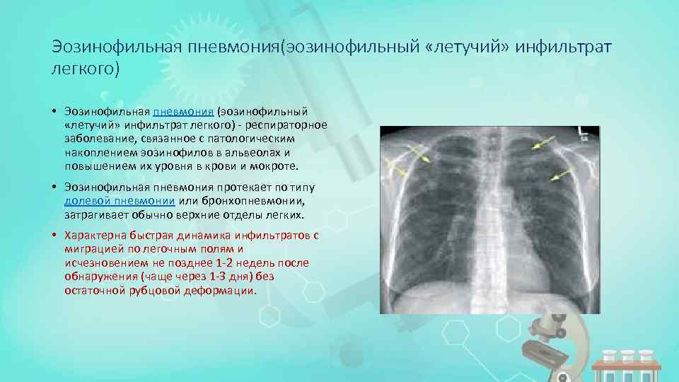 Эозинофильная пневмония(эозинофильный «летучий» инфильтрат легкого) • Эозинофильная пневмония (эозинофильный «летучий» инфильтрат легкого) - респираторное