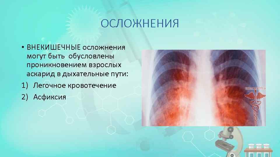 ОСЛОЖНЕНИЯ • ВНЕКИШЕЧНЫЕ осложнения могут быть обусловлены проникновением взрослых аскарид в дыхательные пути: 1)