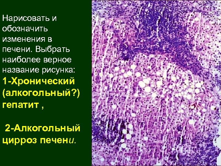 Алкогольный цирроз печени мкб. Алкогольный цирроз печени гистология. Лекарственный гепатит гистология. Алкогольный гепатит морфология. Воспаление печени название.