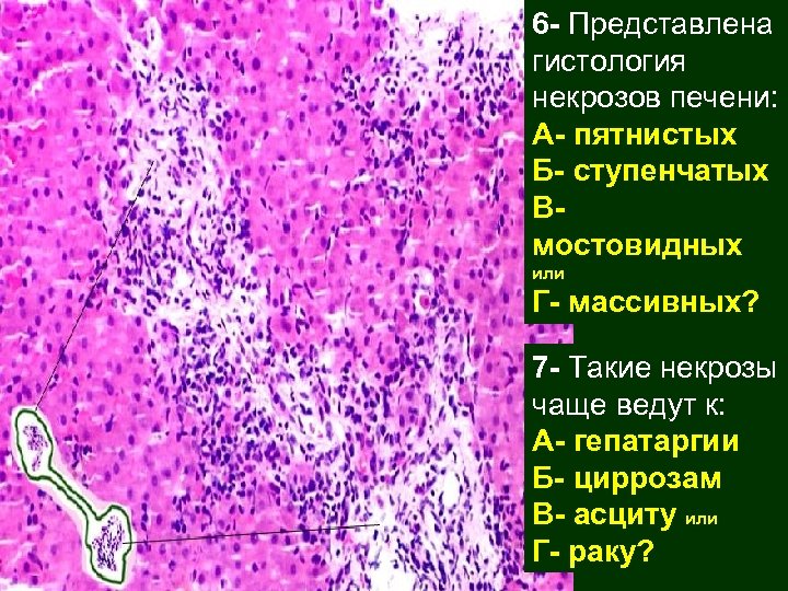 Некроз печени. Центролобулярные некрозы гистология. Центролобулярные некрозы печени гистология. Некроз печени микроскопия. Центролобулярный некроз в печени.