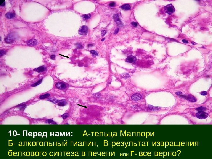 10 - Перед нами: А-тельца Маллори Б- алкогольный гиалин, В-результат извращения белкового синтеза в