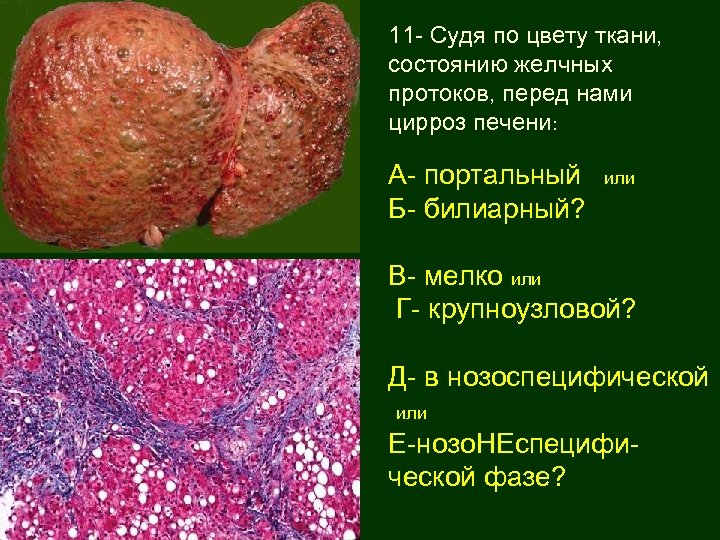 11 - Судя по цвету ткани, состоянию желчных протоков, перед нами цирроз печени: А-