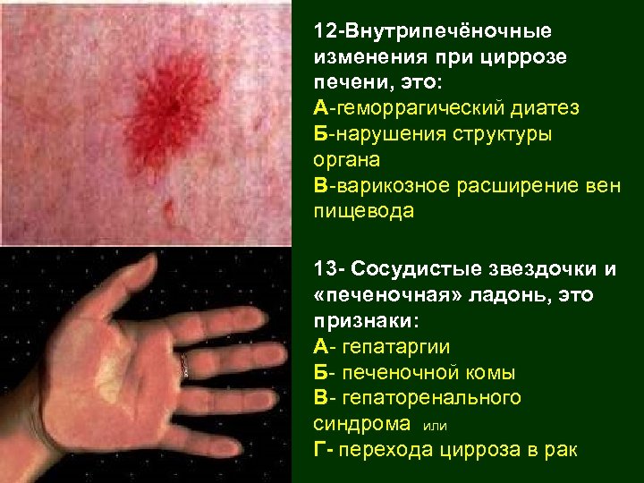 12 -Внутрипечёночные изменения при циррозе печени, это: А-геморрагический диатез Б-нарушения структуры органа В-варикозное расширение