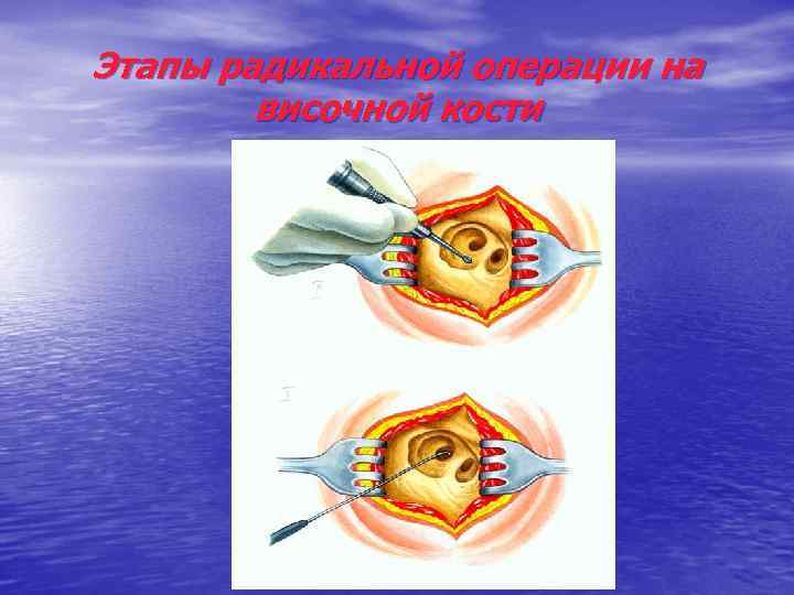 Этапы радикальной операции на височной кости 