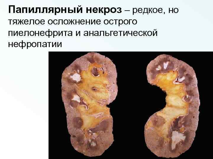 Папиллярный некроз – редкое, но тяжелое осложнение острого пиелонефрита и анальгетической нефропатии 