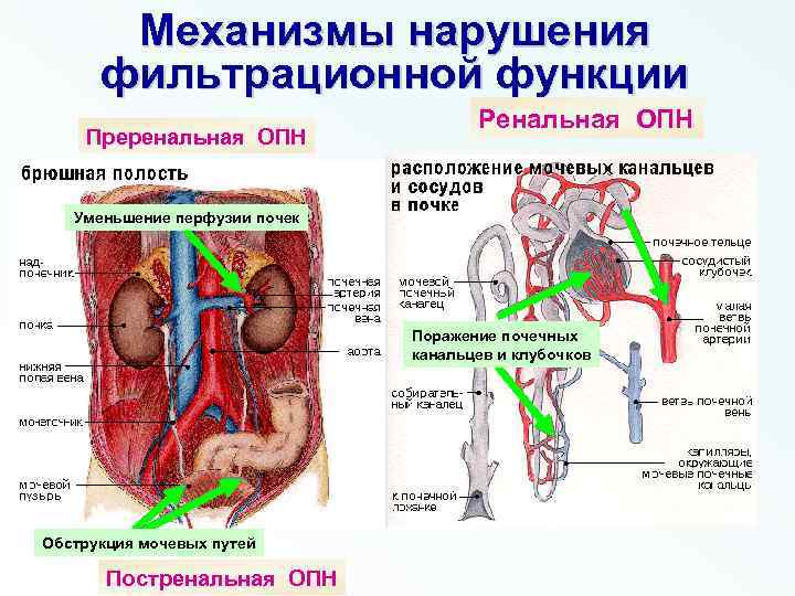 Механизмы нарушения фильтрационной функции Преренальная ОПН Ренальная ОПН Уменьшение перфузии почек Поражение почечных канальцев