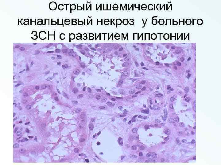 Острый ишемический канальцевый некроз у больного ЗСН с развитием гипотонии 