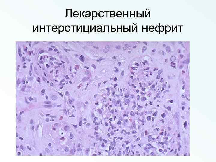 Лекарственный интерстициальный нефрит 