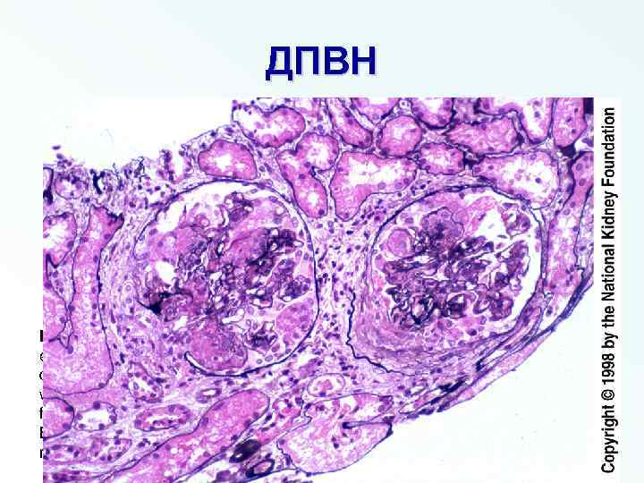 ДПВН Fig 3. The segmental necrosis and proliferation with mild increase in extracapillary cells,