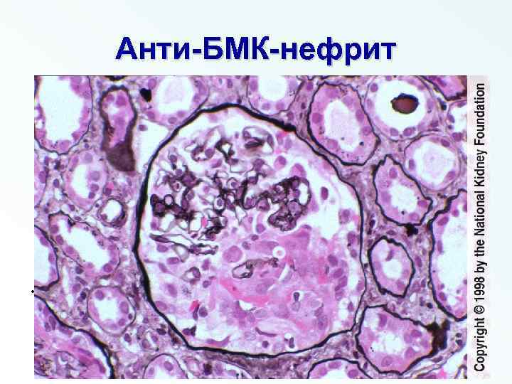 Анти-БМК-нефрит • Fig 2. Early segmental fibrinoid necrosis with early cellular crescent formation without