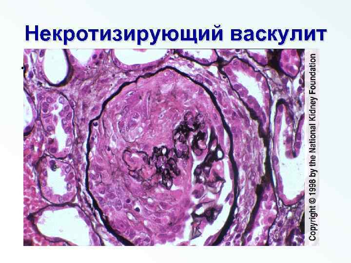 Острая почечная недостаточность картинки