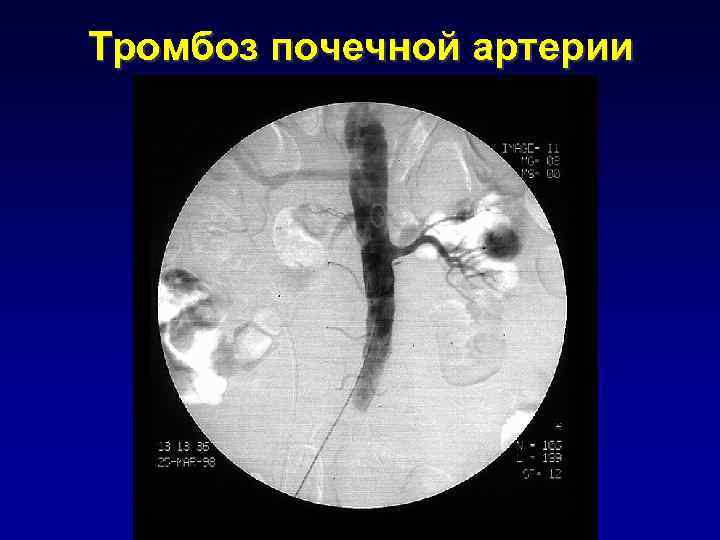 Тромбоз почек. Тромбоэмболия почечных артерий. Ангиография тромбоз почечной артерии. Тромбоз печеночной артерии кт. Тромбоз почечной вены кт.