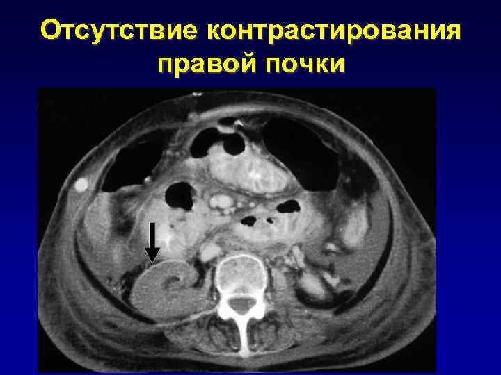 Отсутствие контрастирования правой почки 