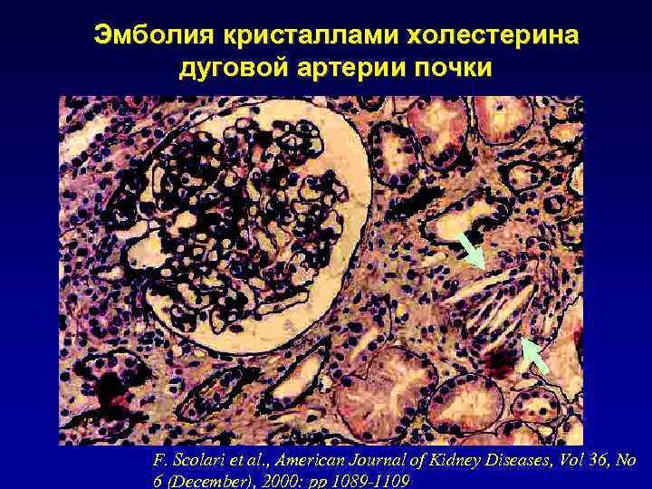 Эмболия кристаллами холестерина дуговой артерии почки F. Scolari et al. , American Journal of