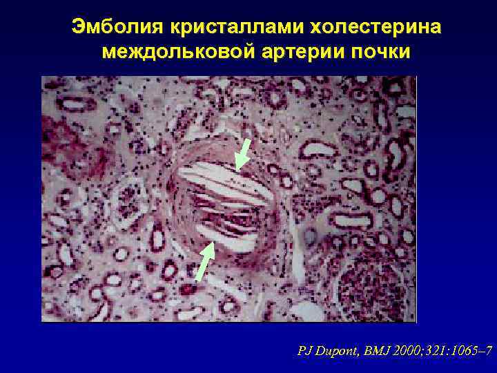 Эмболия кристаллами холестерина междольковой артерии почки PJ Dupont, BMJ 2000; 321: 1065– 7 