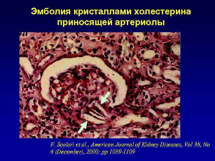 Эмболия кристаллами холестерина приносящей артериолы F. Scolari et al. , American Journal of Kidney