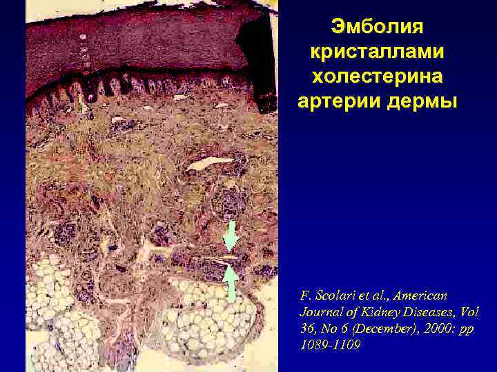 Эмболия кристаллами холестерина артерии дермы F. Scolari et al. , American Journal of Kidney