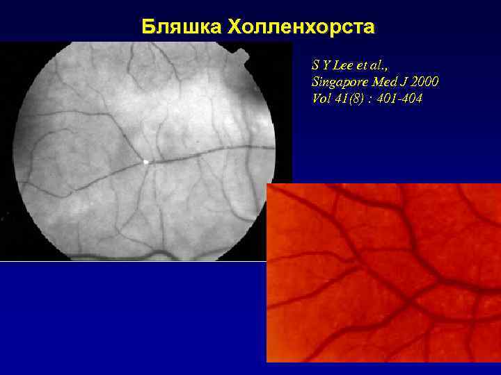 Бляшка Холленхорста S Y Lee et al. , Singapore Med J 2000 Vol 41(8)