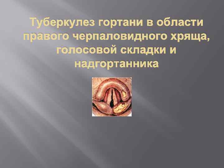 Туберкулез гортани в области правого черпаловидного хряща, голосовой складки и надгортанника 