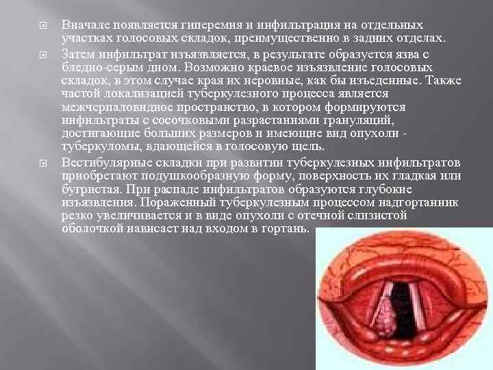  Вначале появляется гиперемия и инфильтрация на отдельных участках голосовых складок, преимущественно в задних